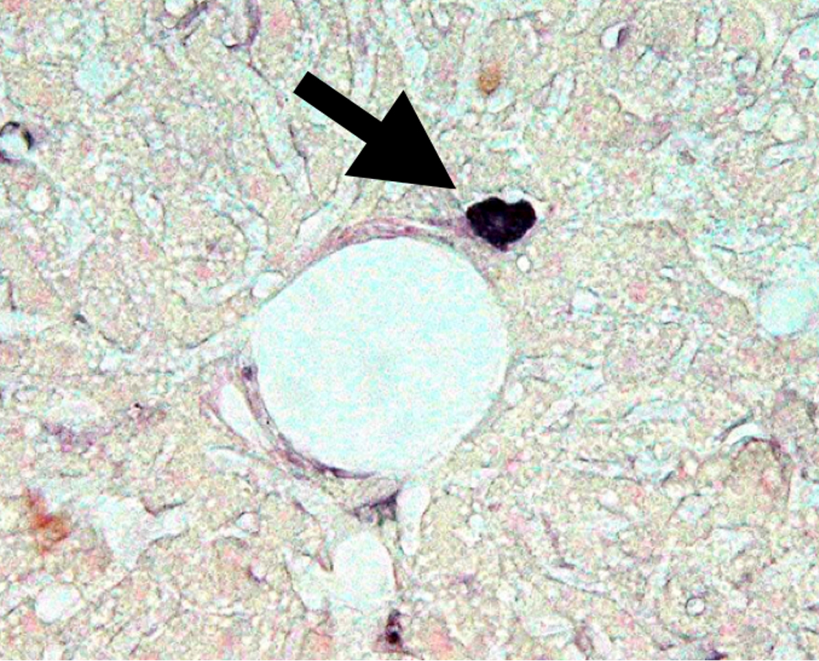 糖尿病幹細胞の発見及び研究